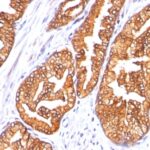 FFPE human prostate carcinoma sections stained with 100 ul anti-Ornithine Decarboxylase-1 (clone SPM565) at 1:300. HIER epitope retrieval prior to staining was performed in 10mM Citrate, pH 6.0.